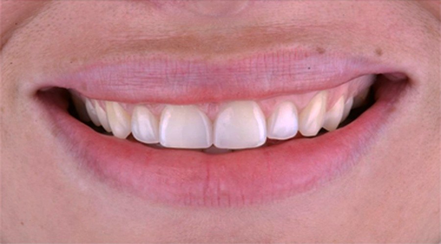 بعد تجميل الاسنان والحشوات التجميل 1